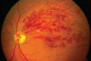 Short cases in ophthalmology