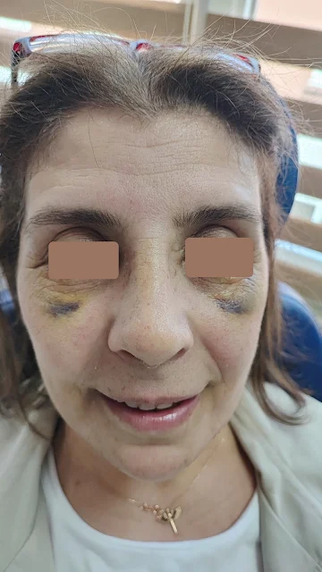 Why Does the Nose Tip Drop After Rhinoplasty?, Pig-like Nose After Nose Job, Excessively Raised Nose Tip After Cosmetic Nose Surgery