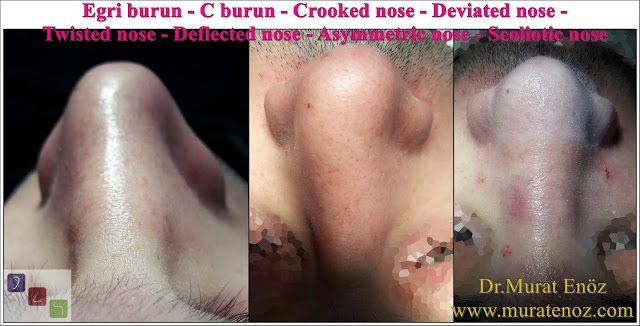 Eğri burun nedenleri - Eğri burun tanımı - Eğri burun estetiği - Eğri burun ameliyatı - Eğri burun tedavisindeki zorluklar - Crooked nose - Deviated nose - Twisted nose - Deflected nose - Asymmetric nose - Scoliotic nose - Eğri burun - C burun - S-shaped crooked nose deformity -  Rhinoplasty Istanbul - Rhinoplasty in Istanbul - Rhinoplasty Turkey - Rhinoplasty in Turkey – Rhinoplasty doctor in Istanbul – ENT doctor in Istanbul - Nose Job in Istanbul - Before and after rhinoplasty photos