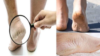 Inilah Tips Menjaga Telapak Kaki Tidak Kering dan Pecah-pecah