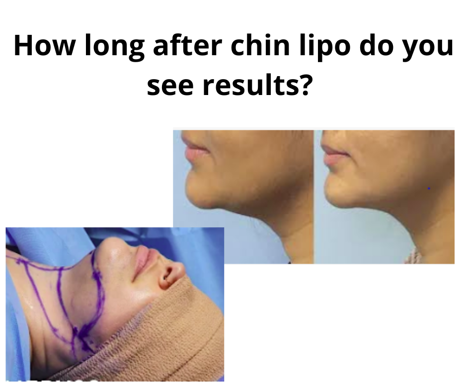 How long after chin lipo do you see results?