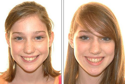 Khách hàng nhận định niềng răng giúp mặt đẹp hơn-2