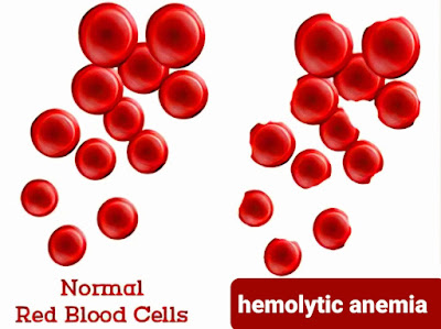 hemolytic anemia   فقر الدم الانحلالي