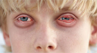 Ligneous Conjunctivitis