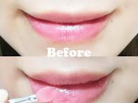 Cara Menghilangkan Bibir Hitam Dan Kering