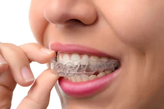 Invisalign Dentist In NW Calgary