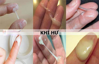 Tổng quan về khí hư bất thường