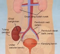 Cara Obati Infeksi Saluran Kemih