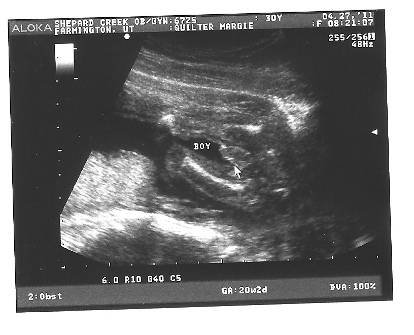 3d ultrasound 20 weeks boy. 3d ultrasound 20 weeks boy.