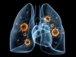 cancro do pulmão tem cura, cancro pulmão esperança de vida, cancro pulmão grau 4, primeiros sintomas cancro pulmão, cancro pulmao taxa sobrevivencia, neoplasia pulmonar sintomas, cancro do pulmão fase terminal sintomas, cancro do pulmão imagens, cancro do pulmão causas