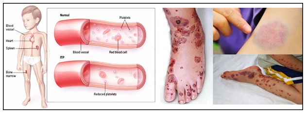 Pengobatan Herbal Purpura Trombositopenia Idiopatik