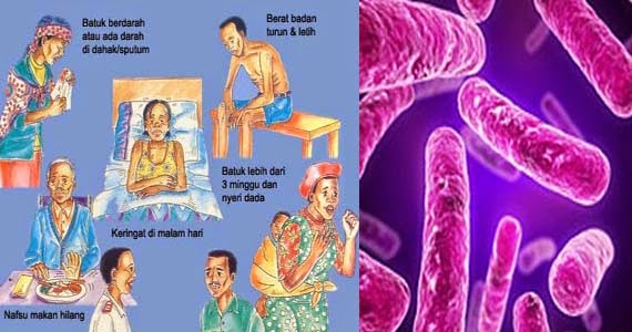 obat penyakit tbc alami