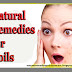 Best Home Remedies for Boils,  Natural Remedies for Boils