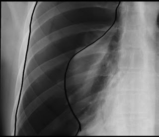 chest xray