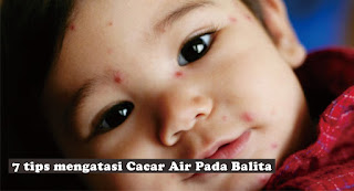 Mengatasi Cacar Air pada Balita