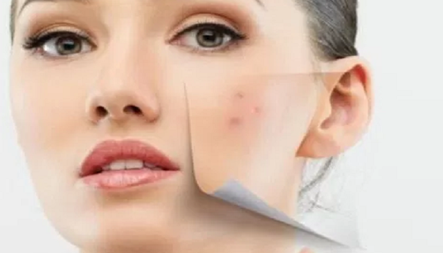 how many tca peels to remove acne scars