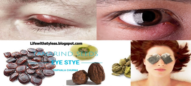 Get Rid Of The Eye Sty With These Effective Home Remedies