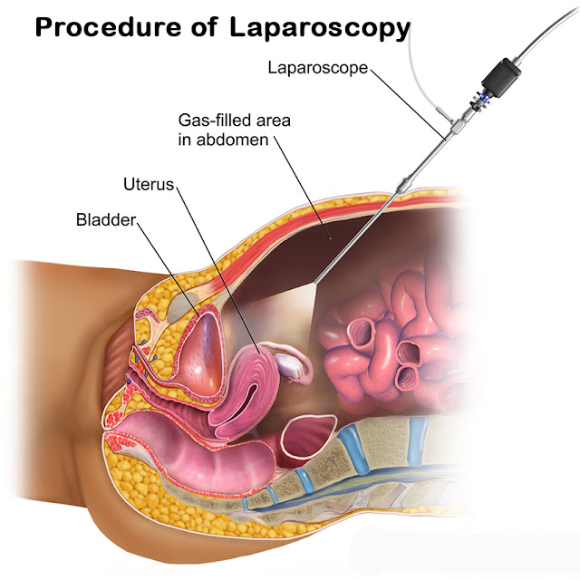 best laparoscopic surgeon in India