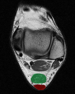 Achilles Tendon in Ankle MRI Anatomy | Radiology Anatomy ...