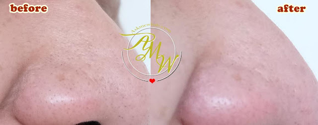 before and after photo of Althea A'BLOOM BHA BLACKHEAD BLASTER 