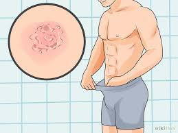 Apa Obat Untuk Penyakit Sipilis Atau Raja Singa Apa Obat Untuk Penyakit Sipilis Atau Raja Singa