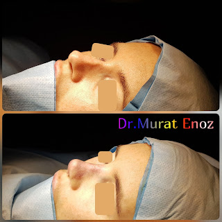 Micromotor Assisted Revision Nose Job, Micro-Motor Assisted Revision Rhinoplasty Operation,Revision Nose Aesthetic Operation in Turkey,