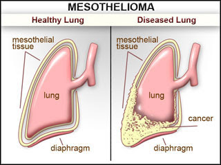 Asbestos Lung Cancer Symptoms