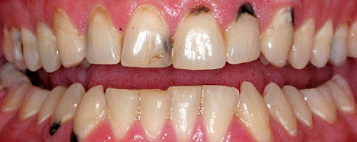 Phương pháp khắc phục răng sâu 