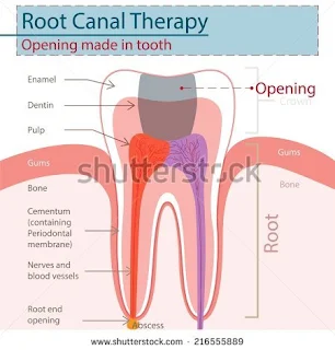 Root Canal Treatment Dubai