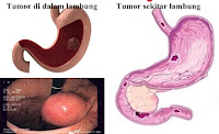 http://naturalmedicineindo.blogspot.com/2015/07/pengobatan-alami-untuk-tumor-lambung.html