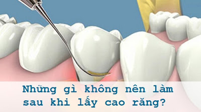 Đọc để biết lấy cao răng xong kiêng ăn gì-1