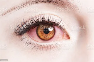 Eye flu ka ilaj, eye flu treatment, aankh aana kya hai