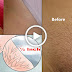 If You Want To Remove Pubic Hair Permanently Then Try This Simple Home Method