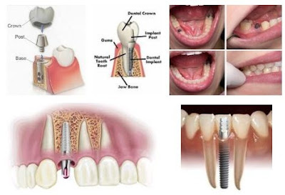 quy-trinh-cay-ghep-implant