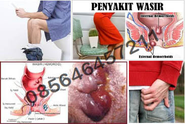 Penyakit Wasir (Hemoroid), Kenali Gejala dan ciri cirinya