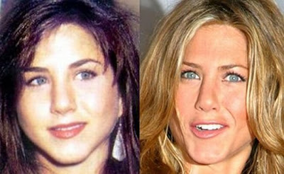 celebrity plastic surgery