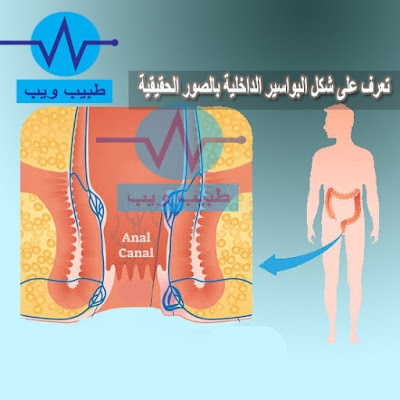 تعرف على شكل البواسير الداخلية بالصور الحقيقية