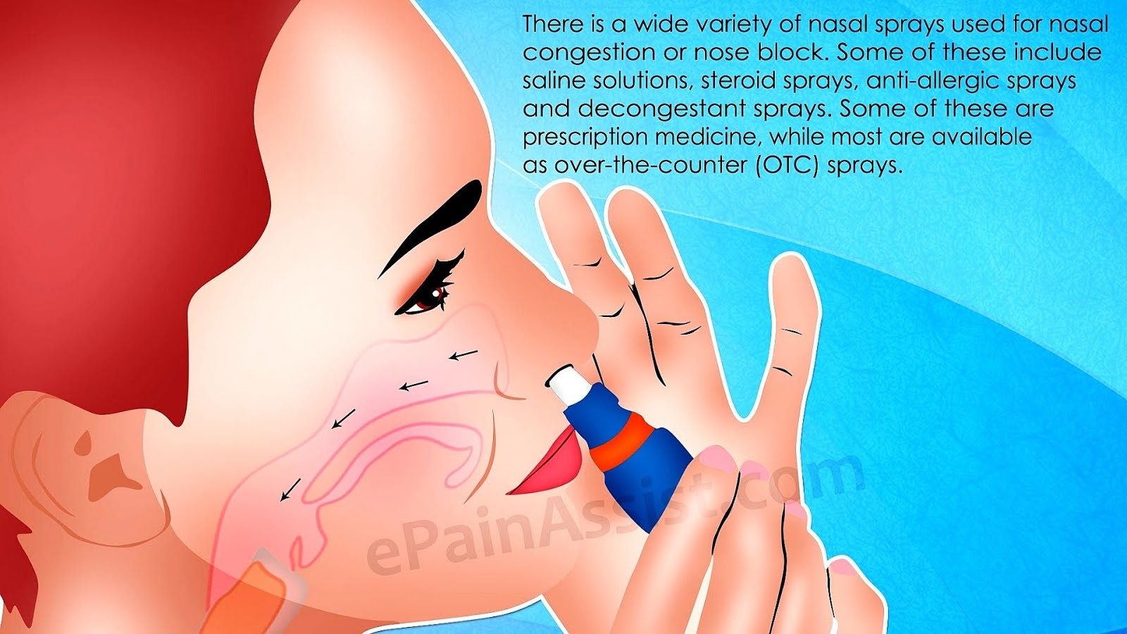 Steroid Nasal Spray Side Effects Effect Choices