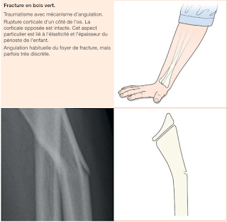 Fracture en bois vert