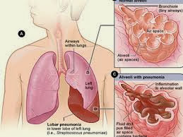 Penyebab Tanda Gejala Bronkopneumonia