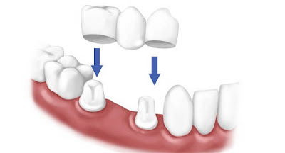 Kỹ thuật cầu răng giúp làm răng giả cố định rất thẩm mỹ