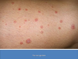 Psoriasis guttata