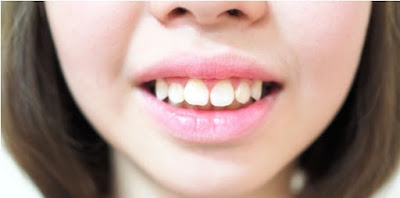 Chữa răng hô tại nhà có hiệu quả không?