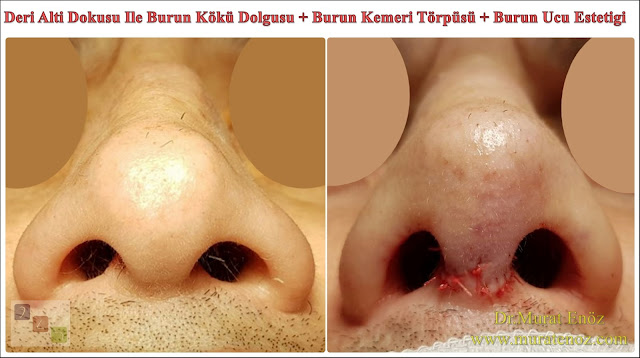 Deri altı dokusu ile burun kökü dolgusu - Burun ucu estetiği - Burun kemeri törpüsü - Kemik kırılmadan burun estetiği - Erkek burun estetiği - Burun kanadı çökmesi tedavisi - Burun ucu kaldırma - Burun ucu daraltma - Lokal anestezi altında burun estetiği