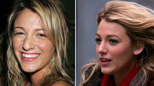 blake lively nose job before and after. Blake Lively Zac Efron