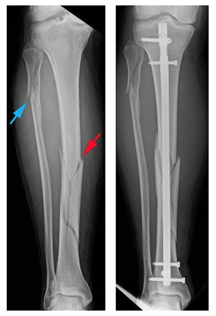 Tibial Fracture Treatment | Tibial Bone Fracture Surgery