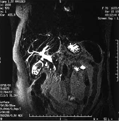 Magnetic Resonance CholeoPancreatography, MRCP, pemeriksaan penunjang, imaging, pencitraaan, radiologi, Kolangiopankreatografi resonansi magnetik, batu empedu, kolesterol, pigmen, hiperekoik, hipoekoik