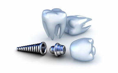 Cấy ghép răng implant giá bao nhiêu-3