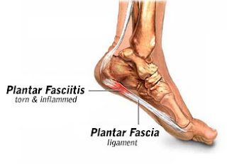 Obat Tradisional Plantar Fasciitis