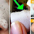 Home Remedies for Remove Blackheads Permanently